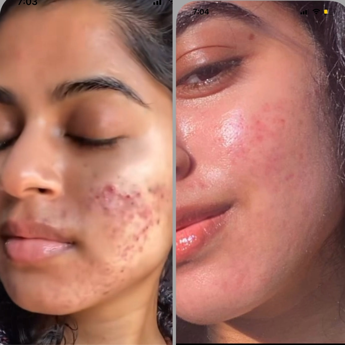 Acne Face Wasg Result before and after image