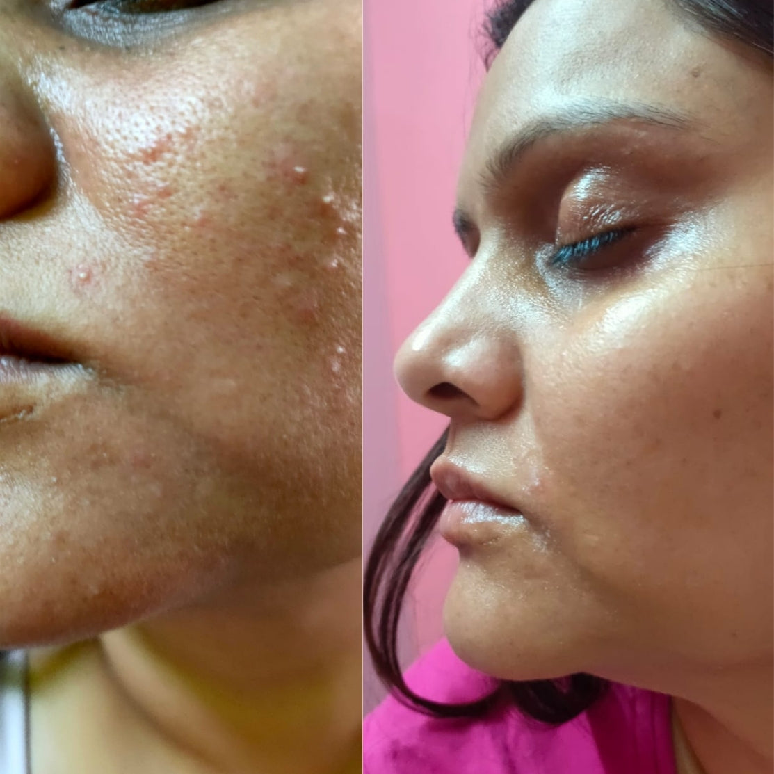 Customer share her feedback about Acnedrying Serum Texture after using our product she seen a huge change on her face.