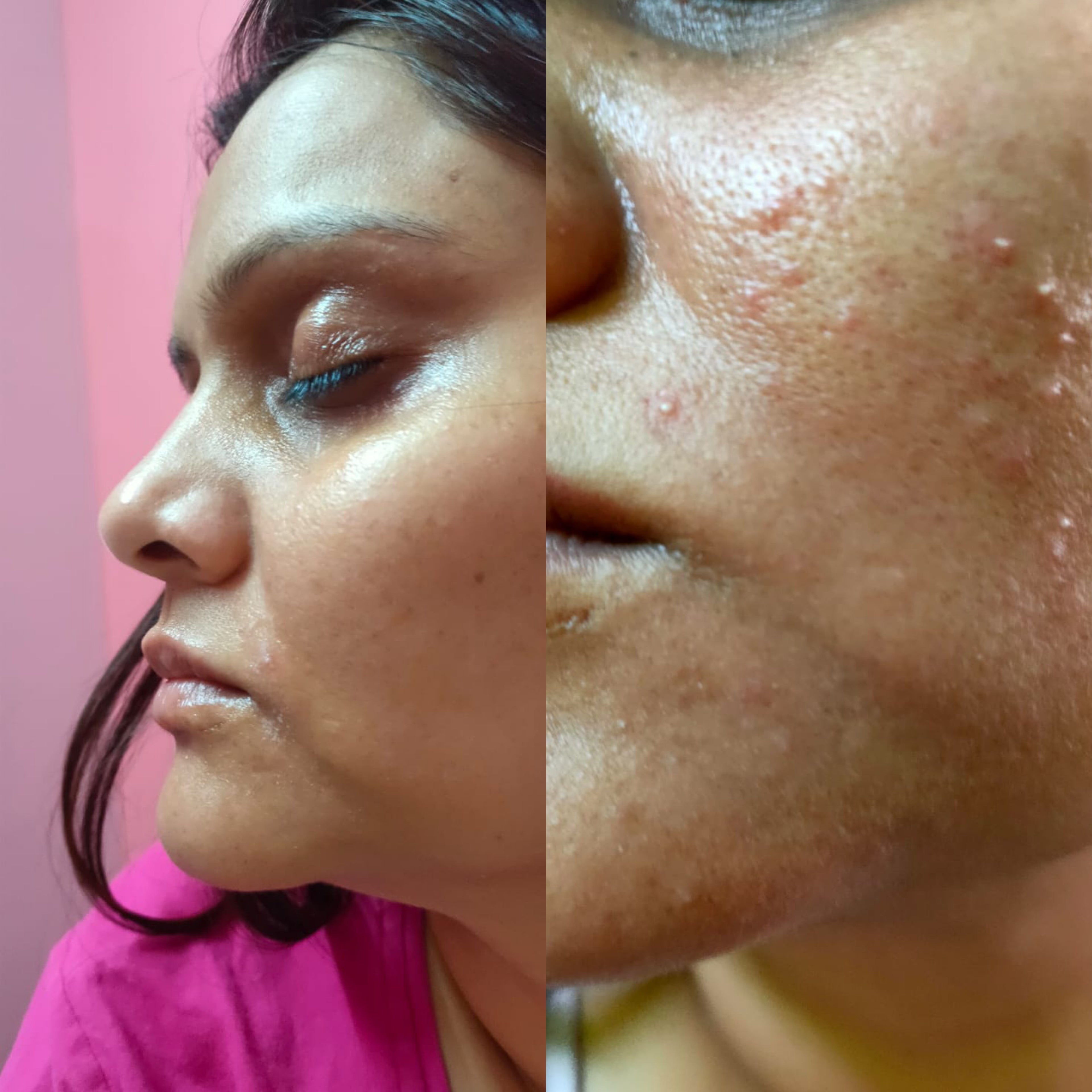 Before and After image using collagen serum by HOB India - Old product image 2.5