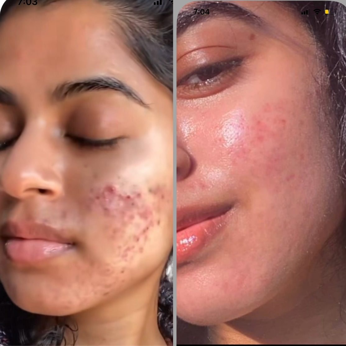 Before and After result of using Acnedrying Serum Texture
