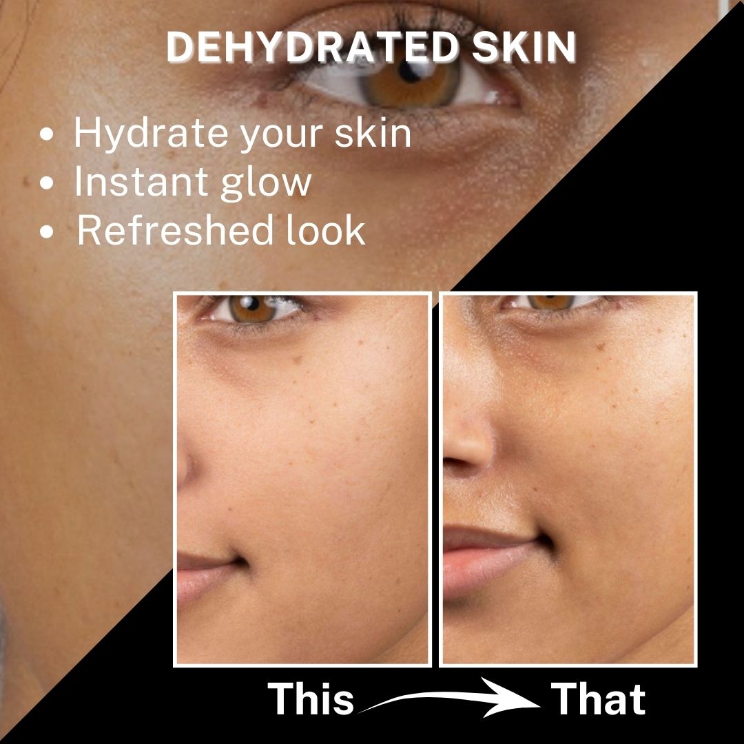 “Close-up of facial skin labeled ‘Dehydrated Skin’ with a before-and-after comparison showing a refreshed and hydrated appearance.”