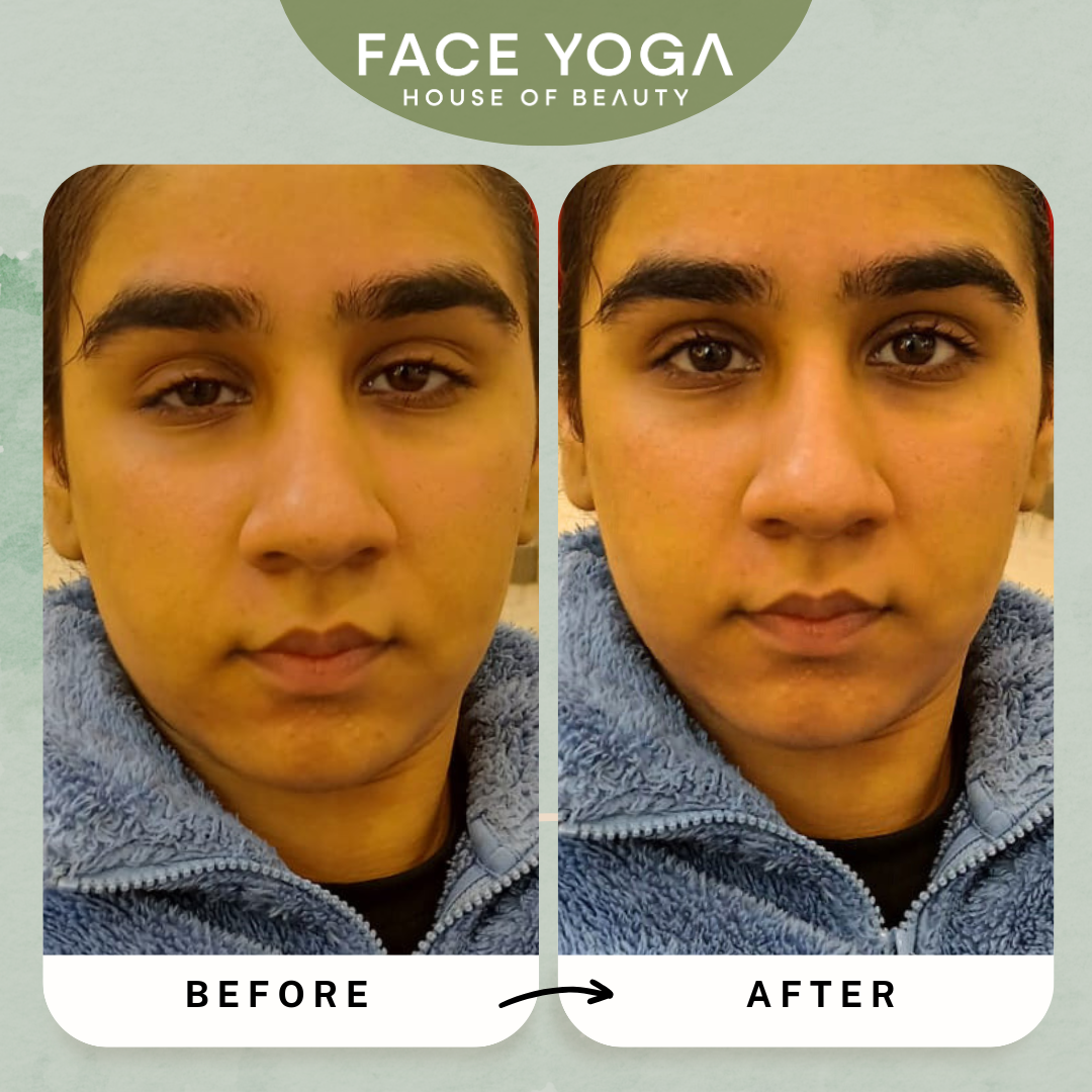 Droopy eyelid correction by face yoga online video program with Vibhuti Arora