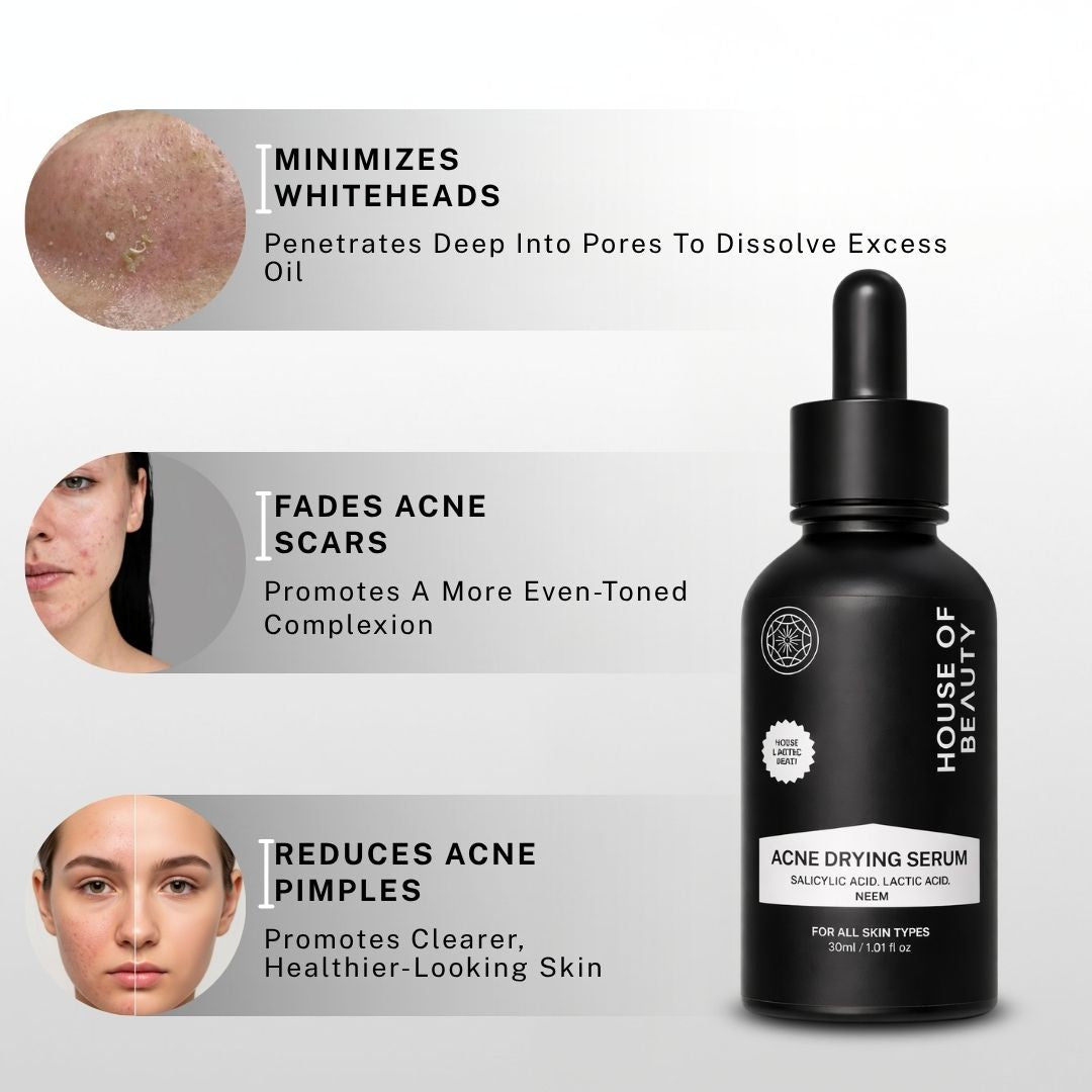 House of Beauty Acne Drying Serum results – minimizes whiteheads, fades acne scars, reduces acne pimples for clearer healthier-looking skin