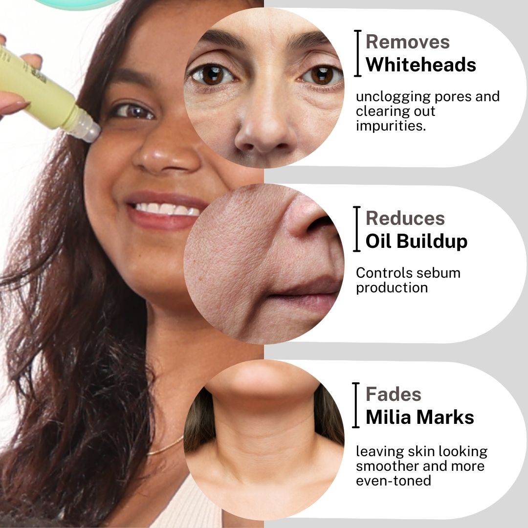 House Of Beauty India Skin Care Milia Serum (15ml) Face Yoga gym Vibhuti Arora facegym Jade roller Guasha skingym Guasha Teacher Training Learn Yoga certified FaceTools Make up Anti ageing Milia Serum (15ml)