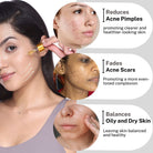 House of Beauty India Superfood Acne Oil Serum (30ml) a potent blend of tea tree oil, avocado oil, and vitamin E for clear, smooth, and acne free skin. Deep cleansing, anti-inflammatory, and antibacterial properties target acne at its root.