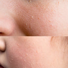 Before and after image of using Milia Serum on your face by HOB India - Old Product Image