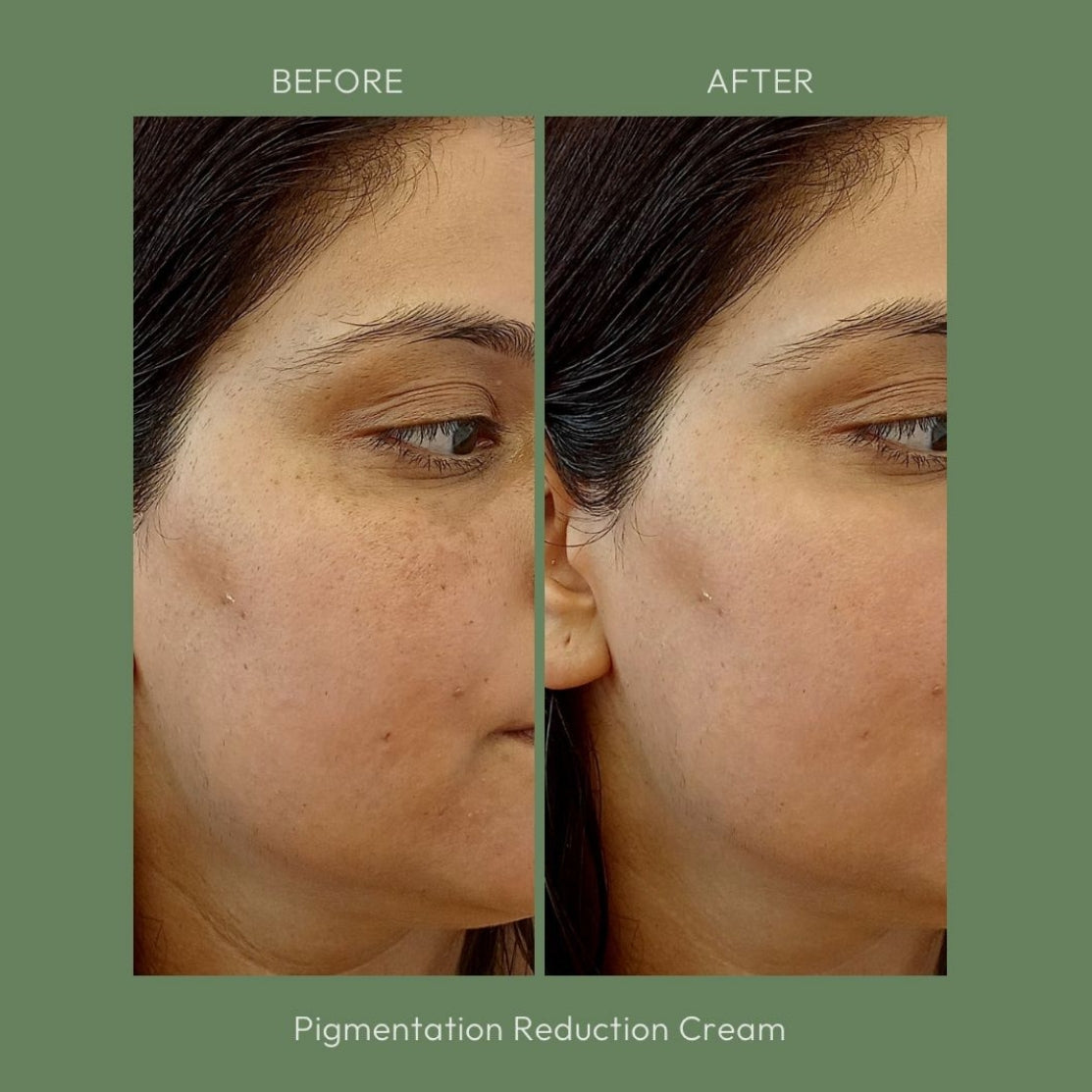 Before and After Pigmentation cream uses old image