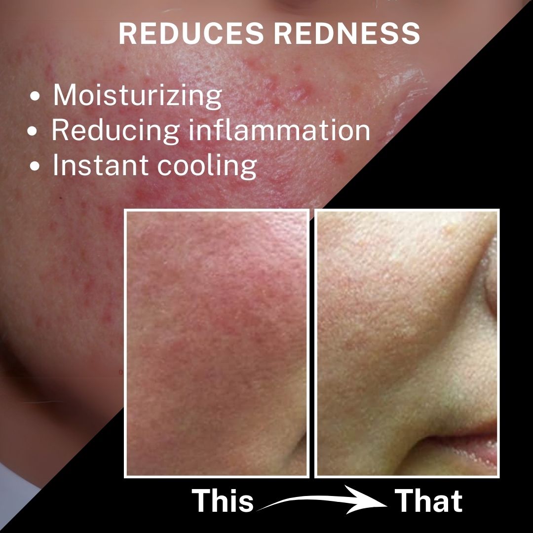 An infographic titled "REDUCES REDNESS" highlighting three main features: Moisturizing, Reducing inflammation, and Instant cooling. Below the text is a "This" vs "That" comparison showing a close-up of inflamed, red skin on the left and calmer, less-irritated skin on the right.
