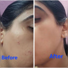 Tea Tree Oil before and After result - Old Product Image by HOB India 5.1.2.3
