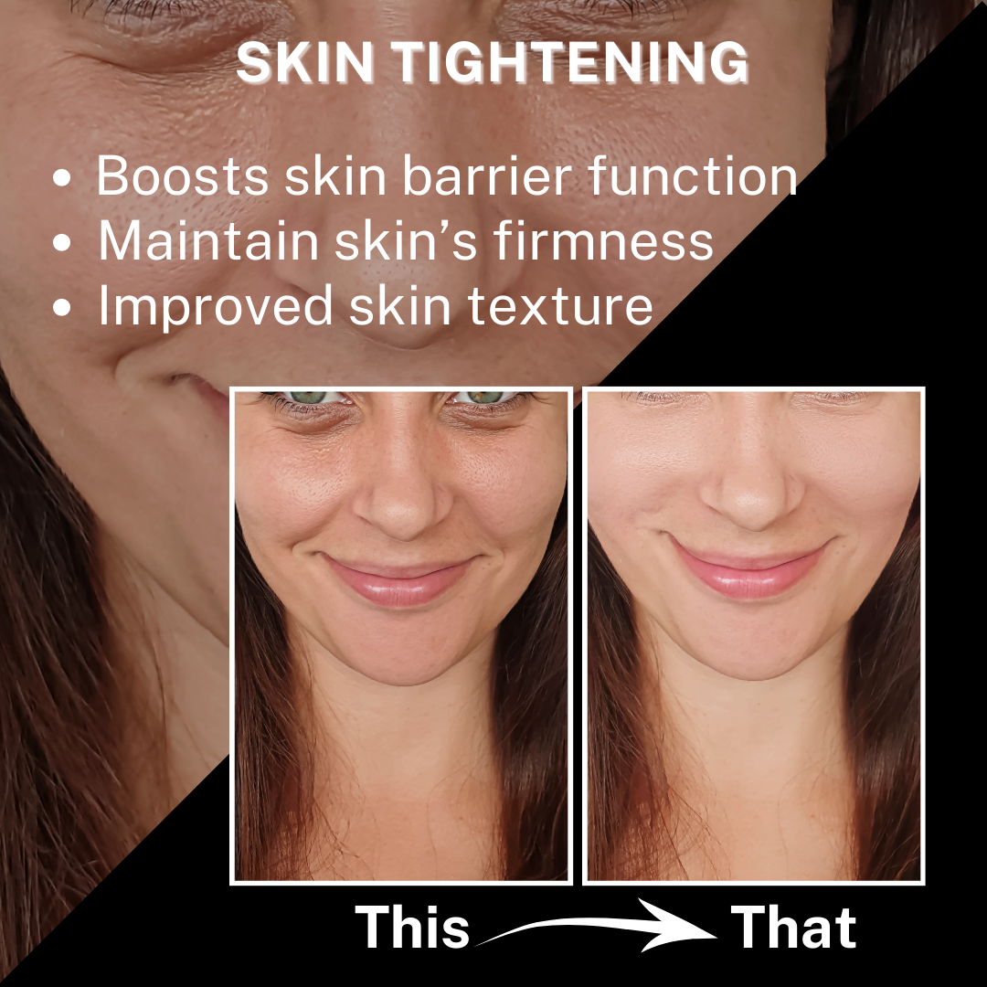 Skin Tightening Before and after Image