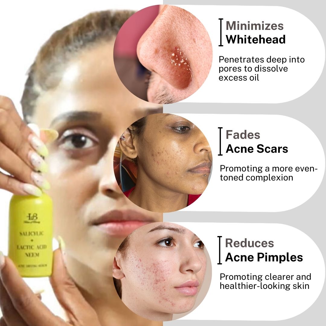 House of Beauty India Acne drying Serum