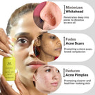 House of Beauty India Acne drying Serum