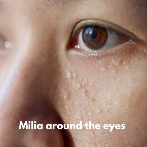 a girl with white bumps of milia around the eyes