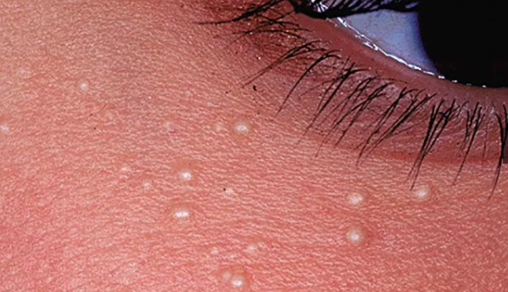 Exfoliate Milia Away In Just 2-3 Weeks AT-Home!