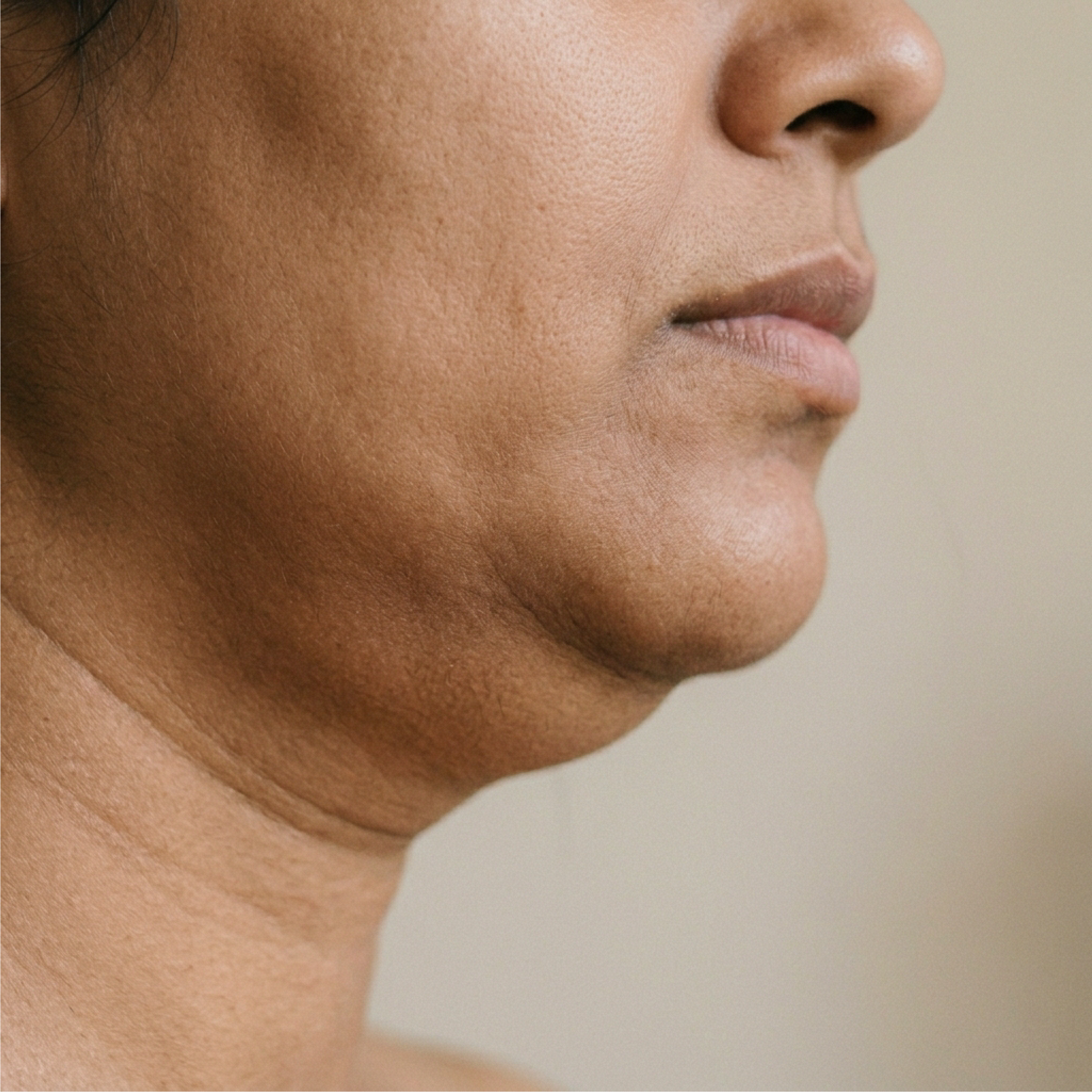 Side profile of a person showing visible fullness and sagging beneath the chin and jawline.