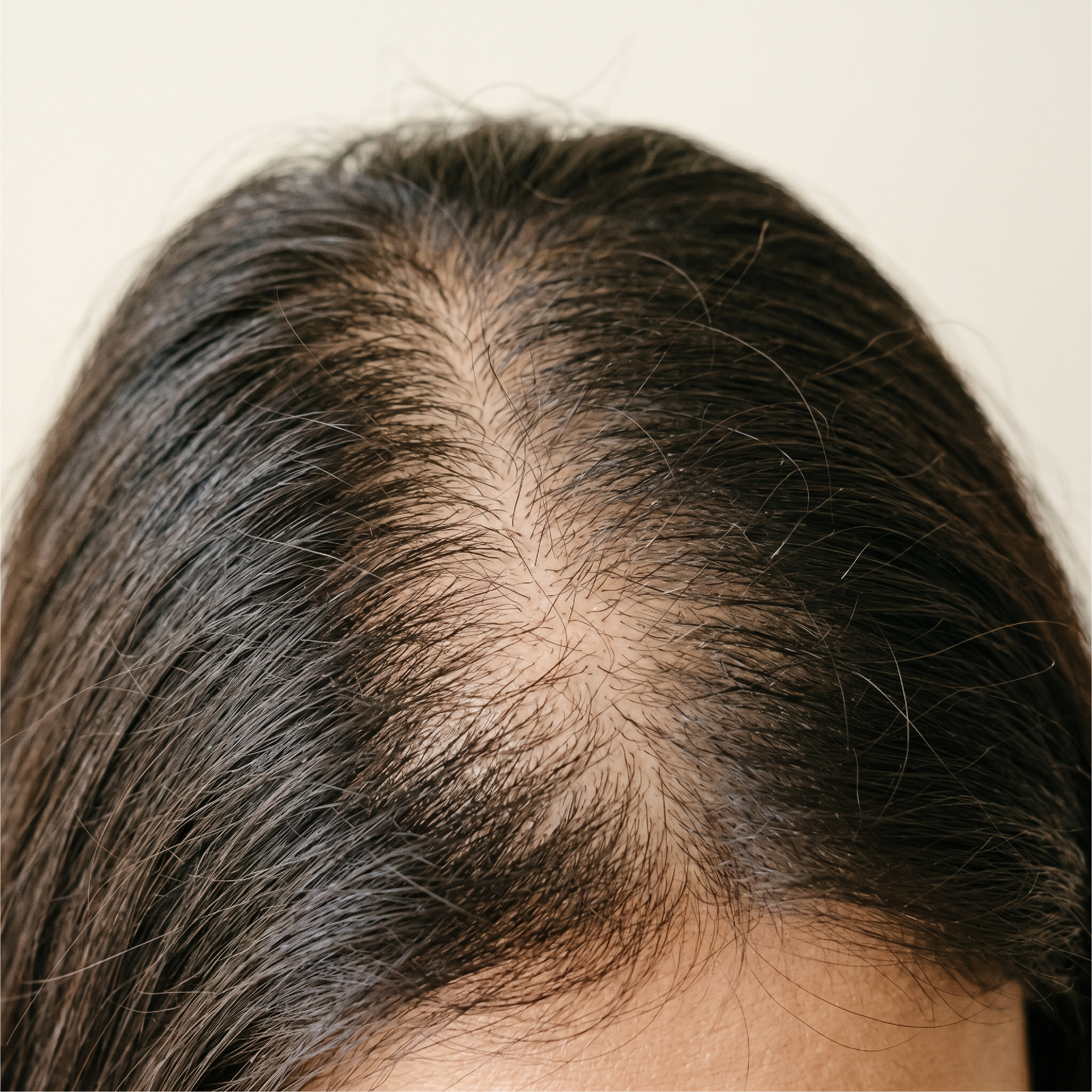 Top view of a person’s scalp showing visible hair thinning and widened hair parting.