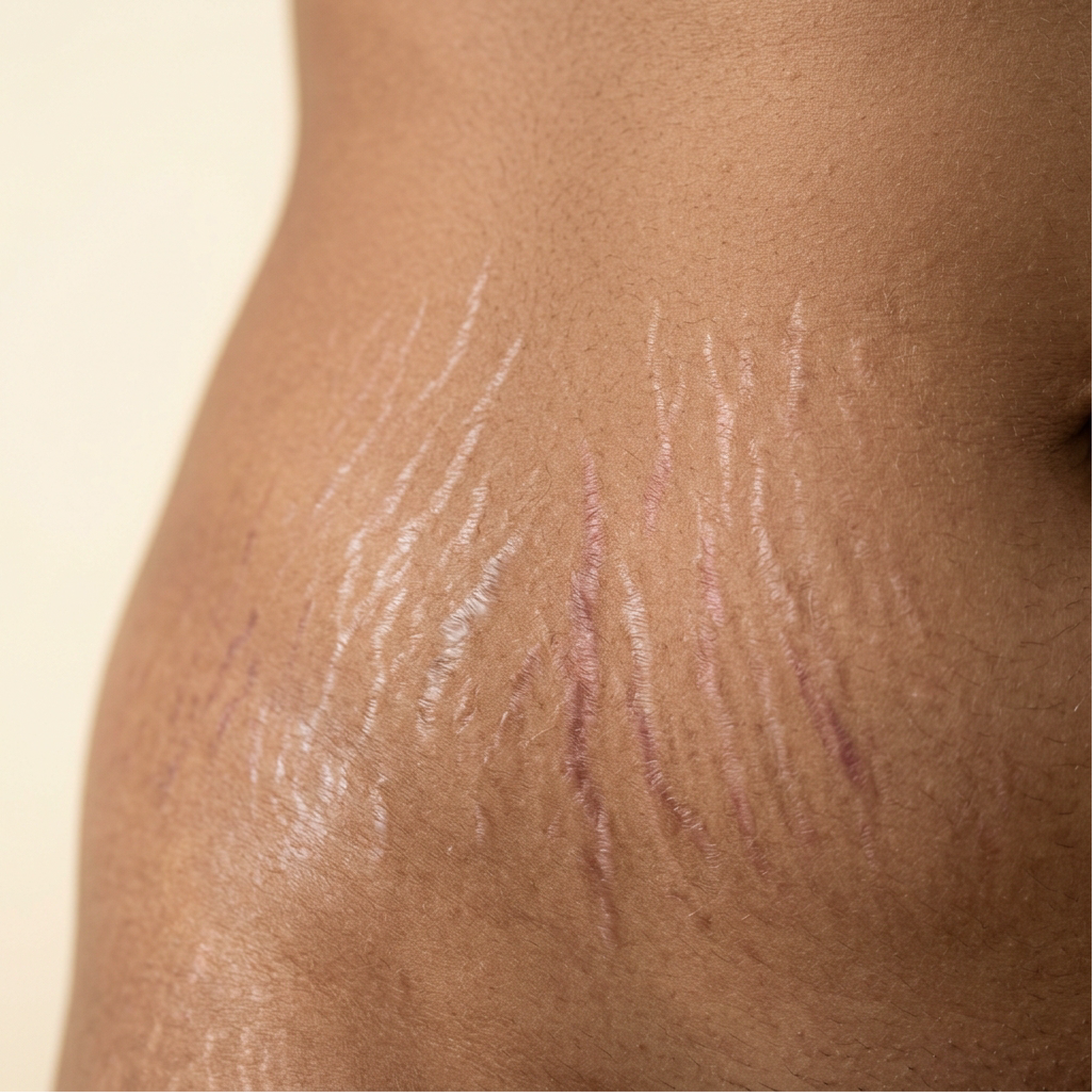 Close-up of skin with visible white and pink stretch marks on the body.