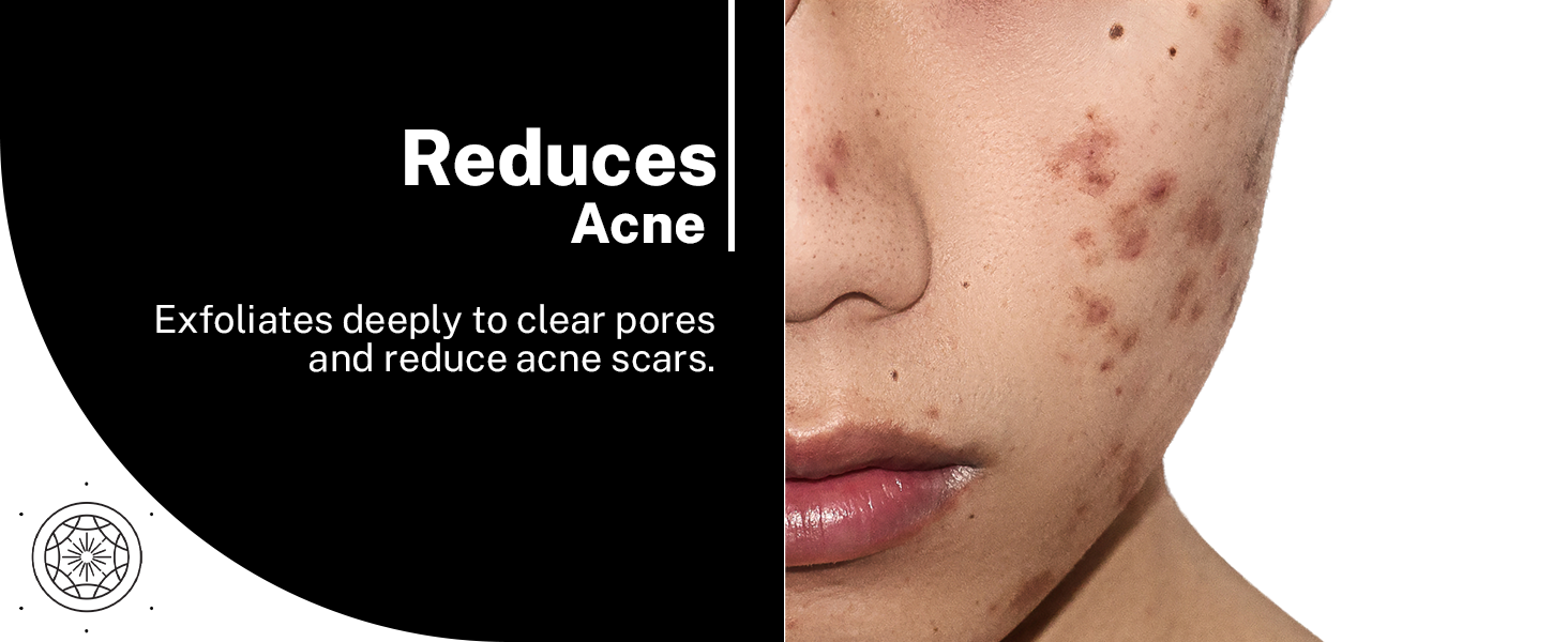 A+ House of beauty Acne Face oil reduces acne