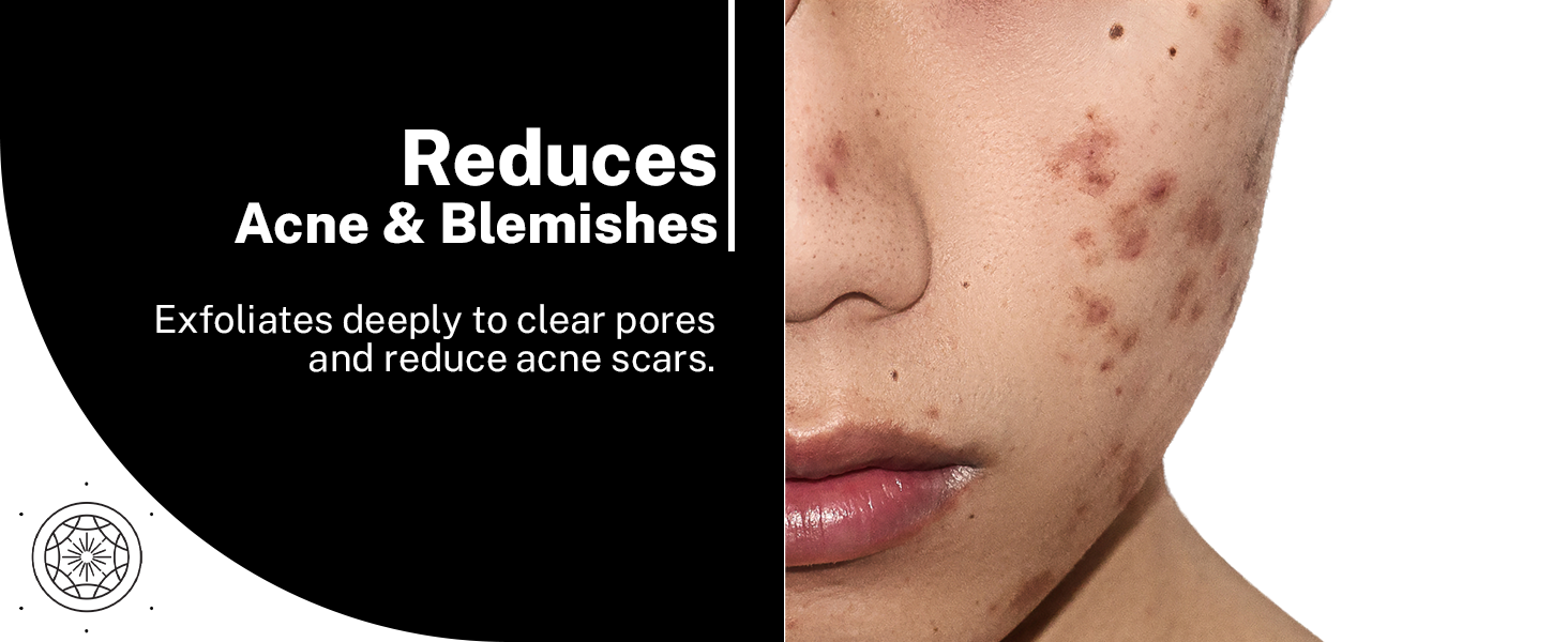 A+ House of beauty Acne drying serum reduces Acne & Blemishes