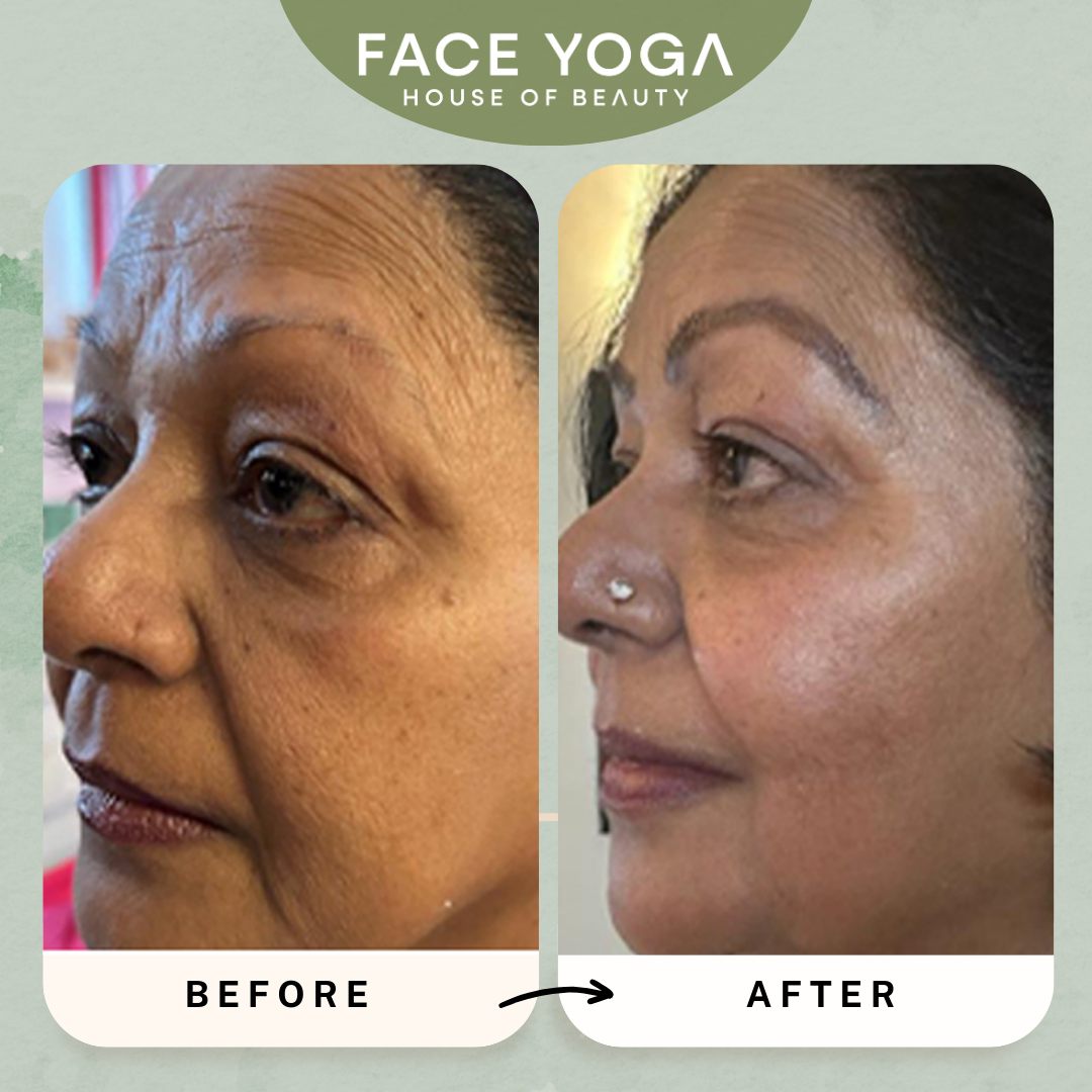 Smile line correction with Face Yoga by Vibhuti Arora (Pre