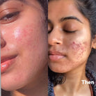 Before and After image of using collagen serum by HOB India - Old Customer review image