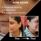 Before and After visual demonstrating results on Acne Scars. Benefits listed: Promote healing, Fade scars, and Improve skin texture.
