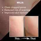 “Before-and-after comparison of skin with milia spots, showing bullet points: clear clogged pores, reduced risk of scarring, and improved skin texture.”
