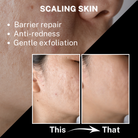 A graphic titled "SCALING SKIN" featuring bullet points for "Barrier repair," "Anti-redness," and "Gentle exfoliation." Below the text is a "This vs. That" comparison showing a close-up of skin with redness and texture on the left, and smoother, clearer-toned skin on the right.